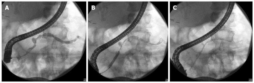 chronic pancreatitis ercp