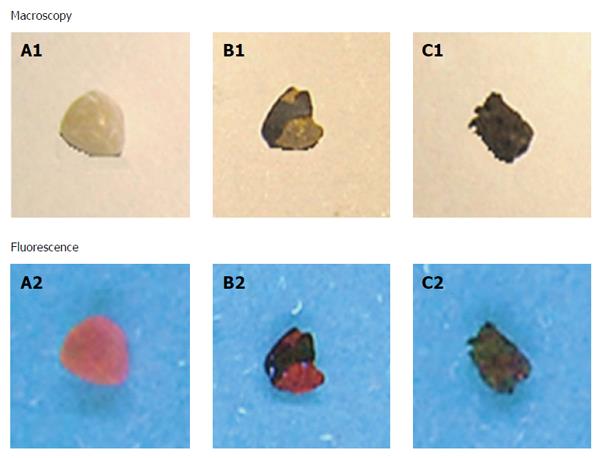 Differential Diagnosis Of Gallstones By Using Hypericin As A Fluorescent Optical Imaging Agent
