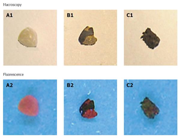 human-gallstone