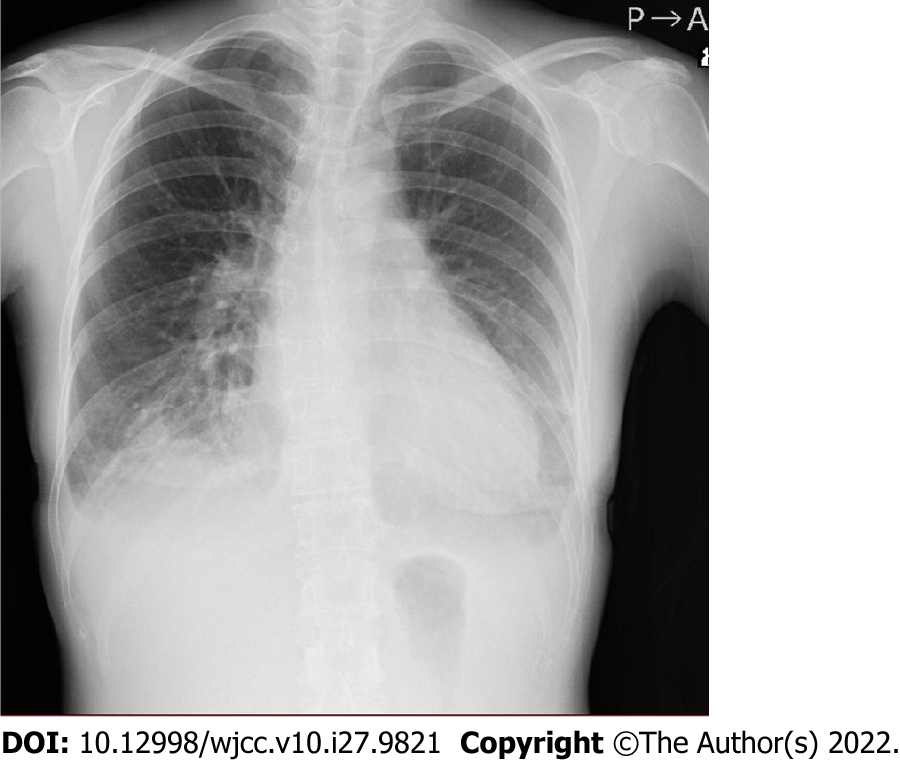 Transposition Of The Great Arteries X Ray