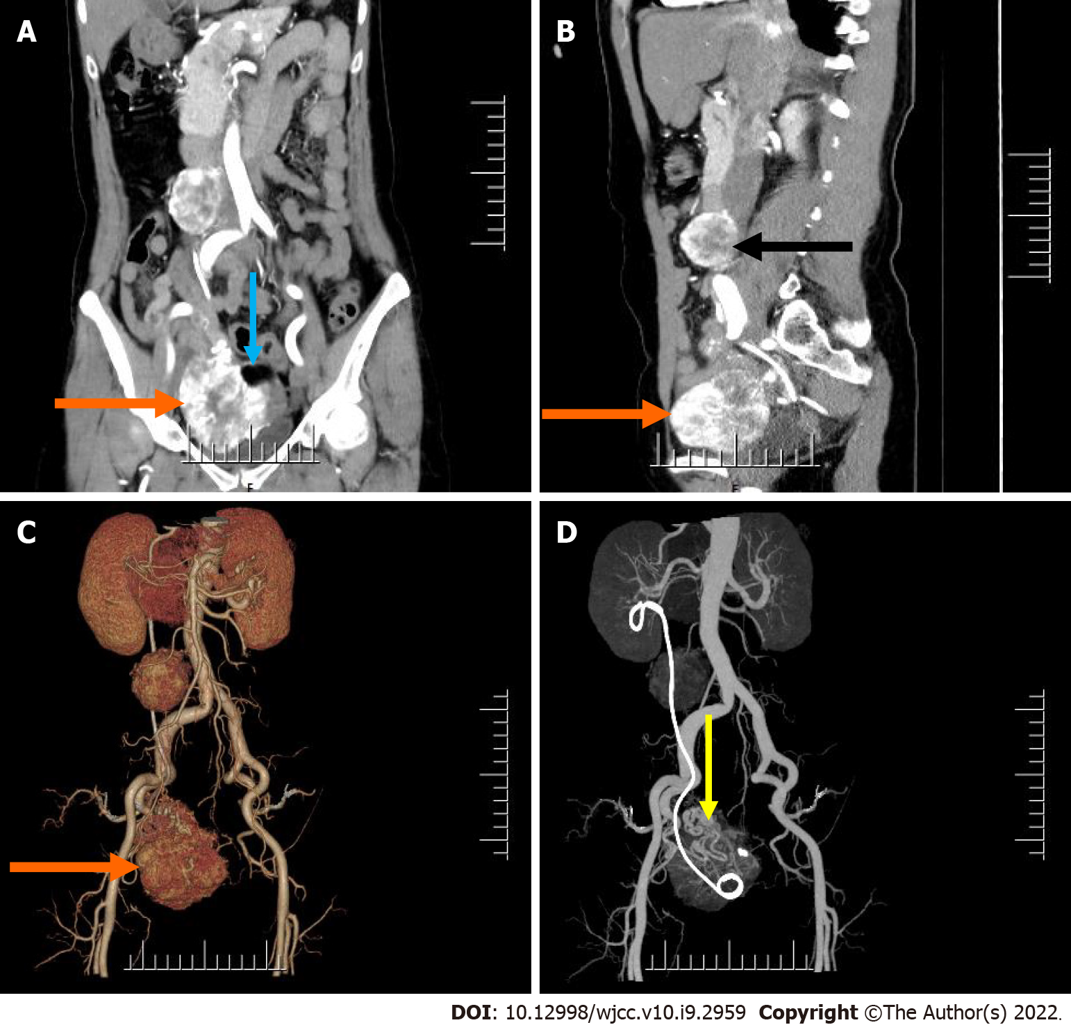 Malignant struma ovarii with papillary carcinoma combined with ...