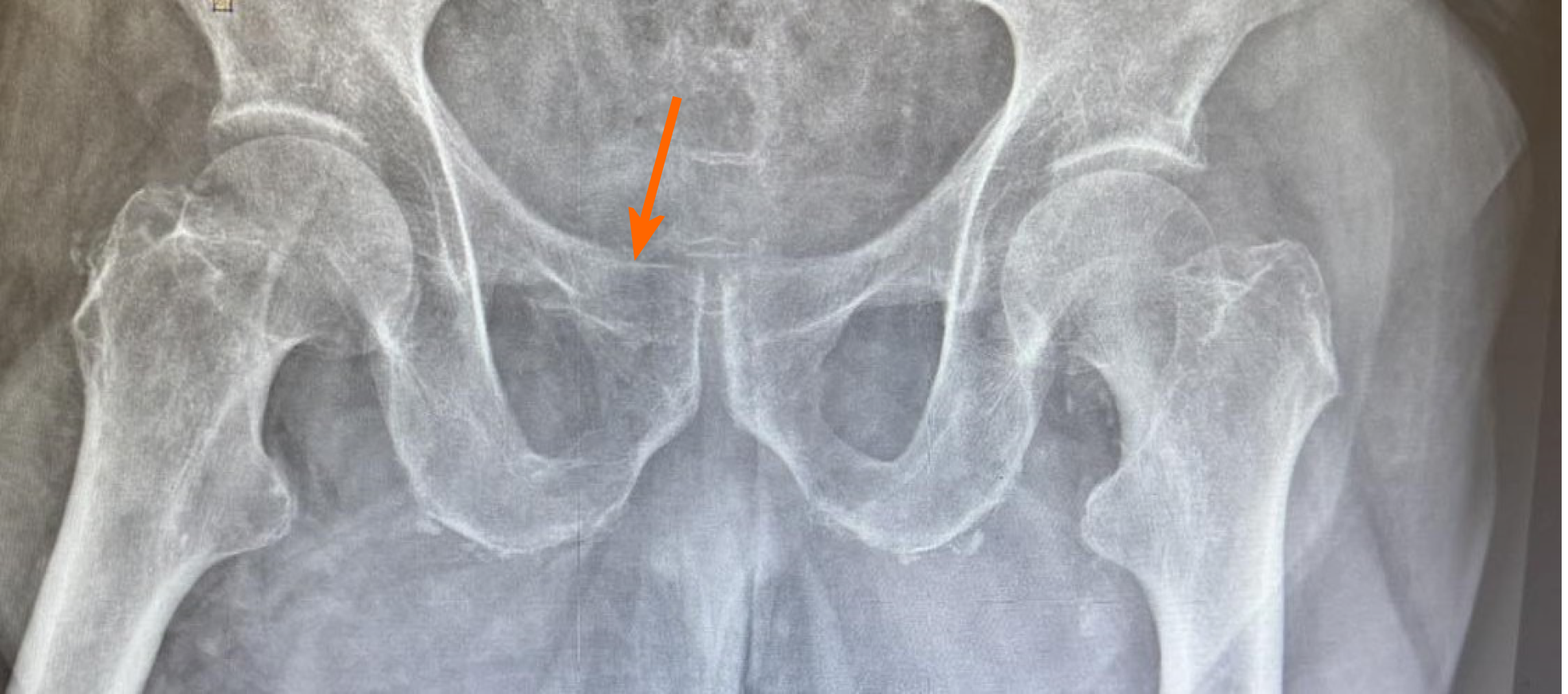 Life threatening Vascular Injury In An Elderly Patient With Isolated 