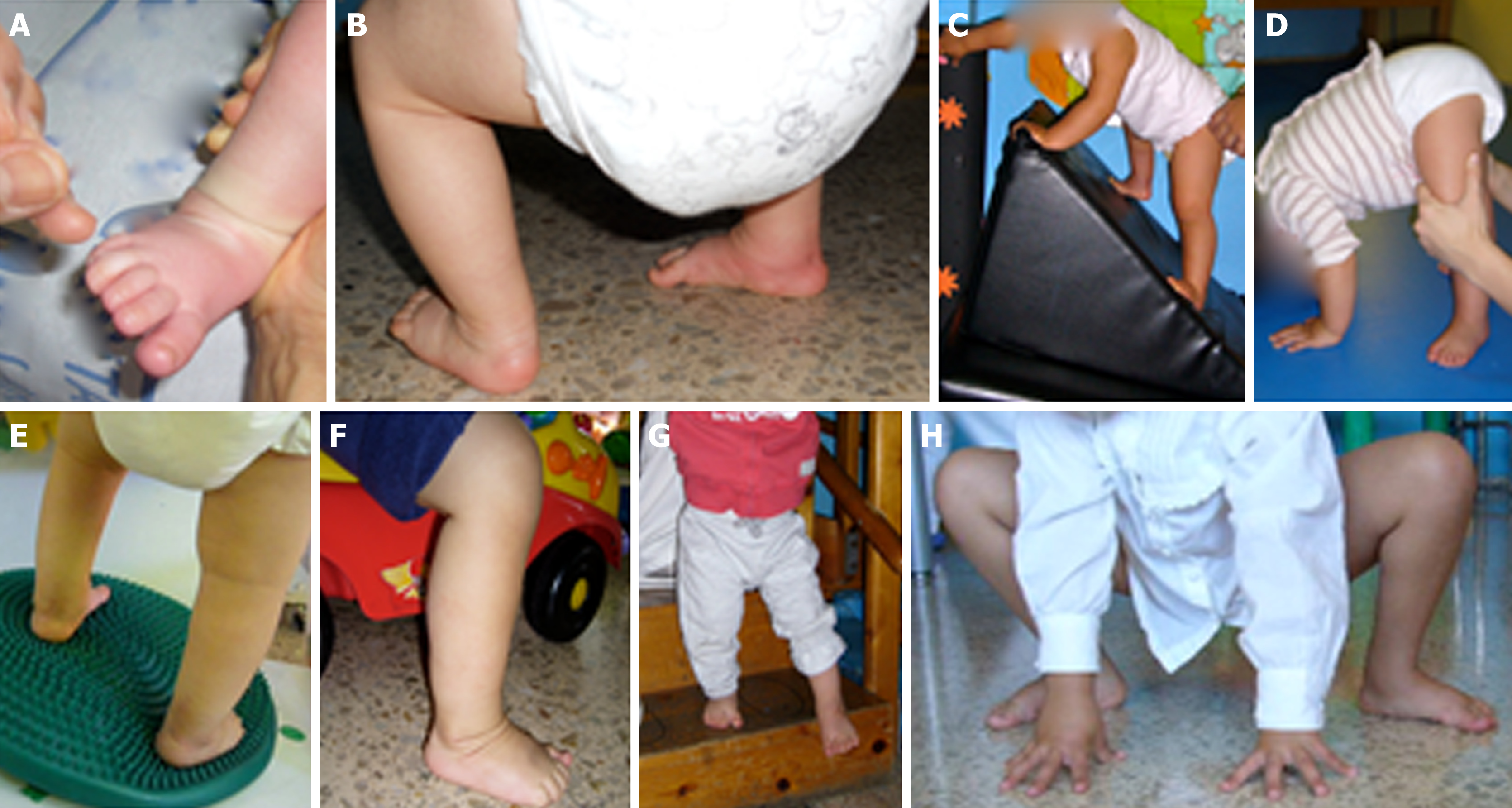 Functional Physiotherapy Method Results For The Treatment Of Idiopathic Clubfoot