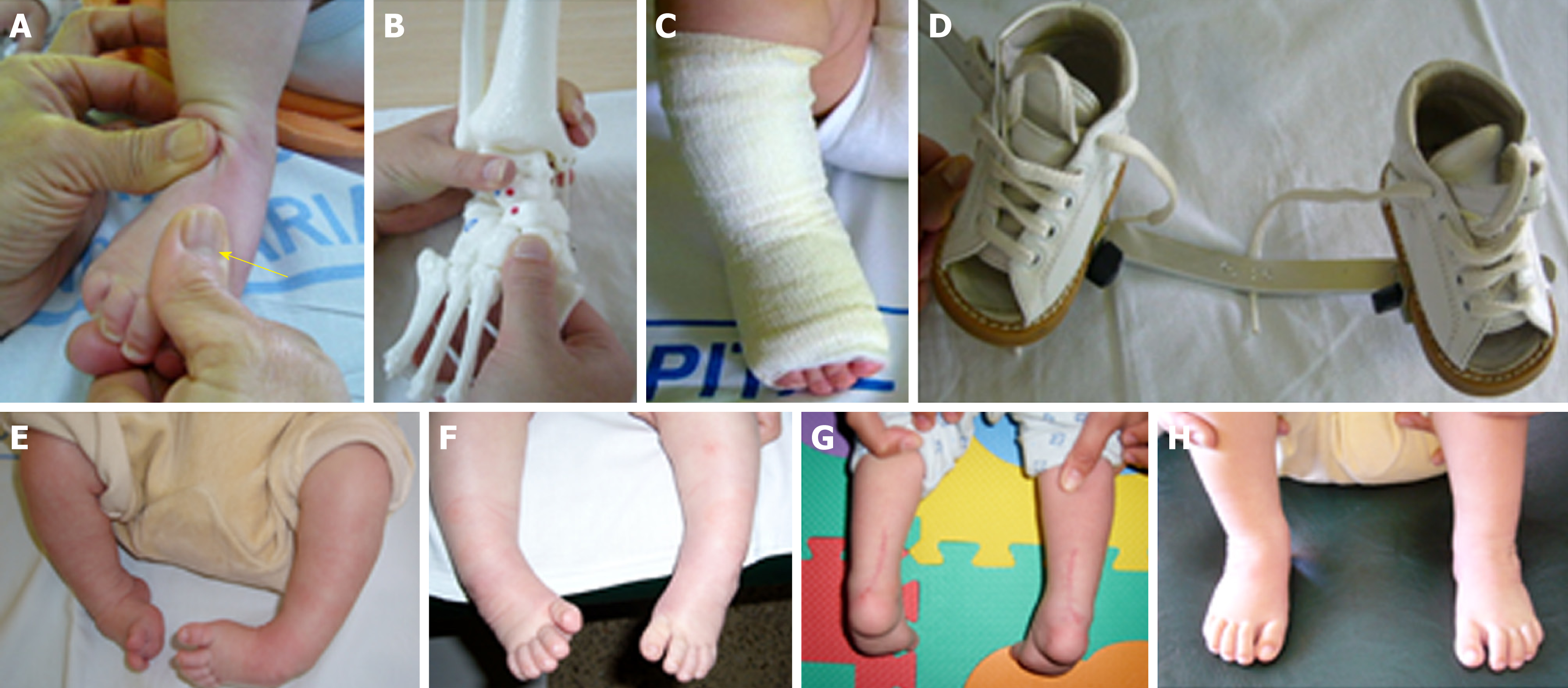 Functional Physiotherapy Method Results For The Treatment Of Idiopathic Clubfoot