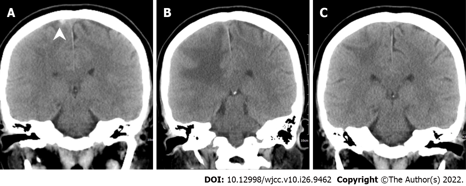 Rapid progressive vaccine-induced immune thrombotic thrombocytopenia ...