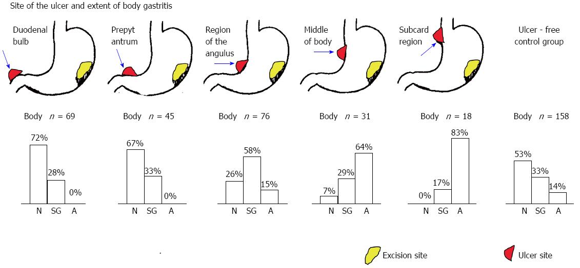 Gastric Ulcer Location