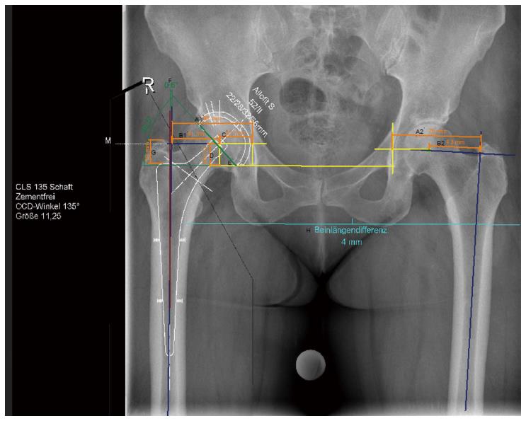 Digital templating in total hip arthroplasty: Additional anteroposterior hip  view increases the accuracy