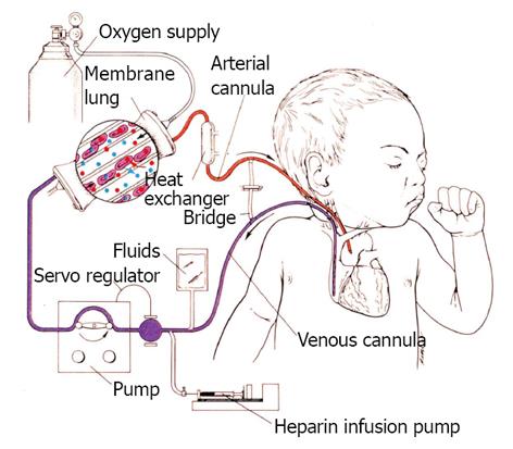 extracorporeal membrane oxygenation