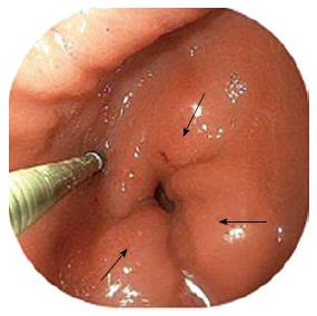 Endoscopic Botox Injections In Therapy Of Refractory Gastroparesis