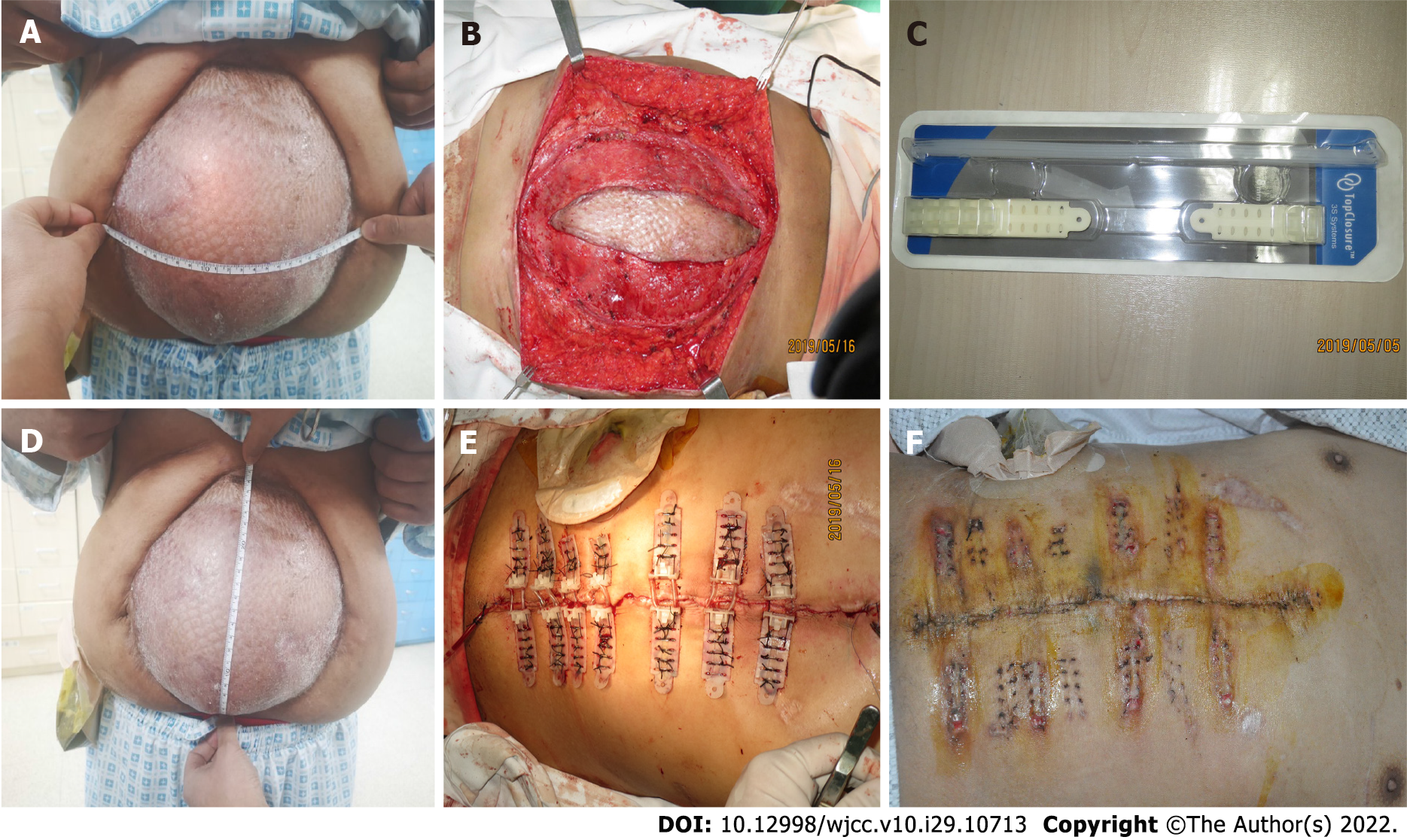 Temporary Abdominal Closure