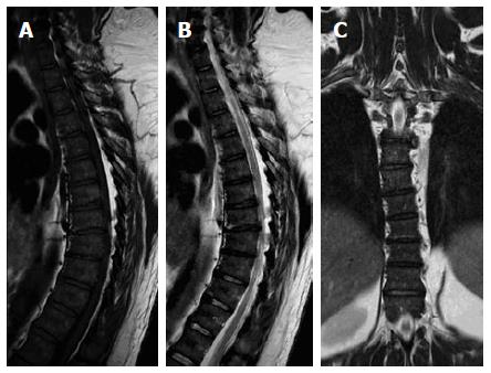 Magnetic resonance imaging of the spinal marrow: Basic 