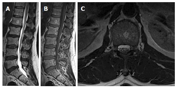 Magnetic resonance imaging of the spinal marrow: Basic 