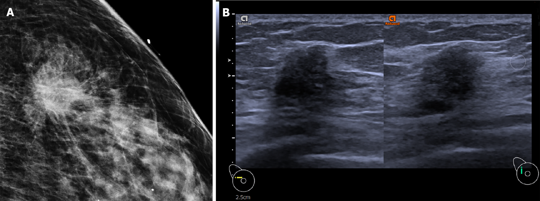 invasive ductal carcinoma ultrasound