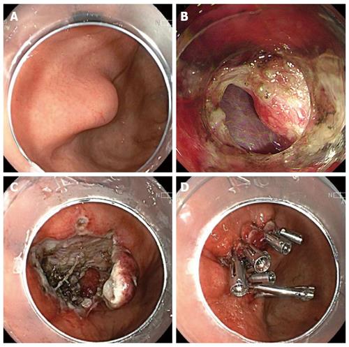 Endoscopic clip closure techniques used in the present study. a