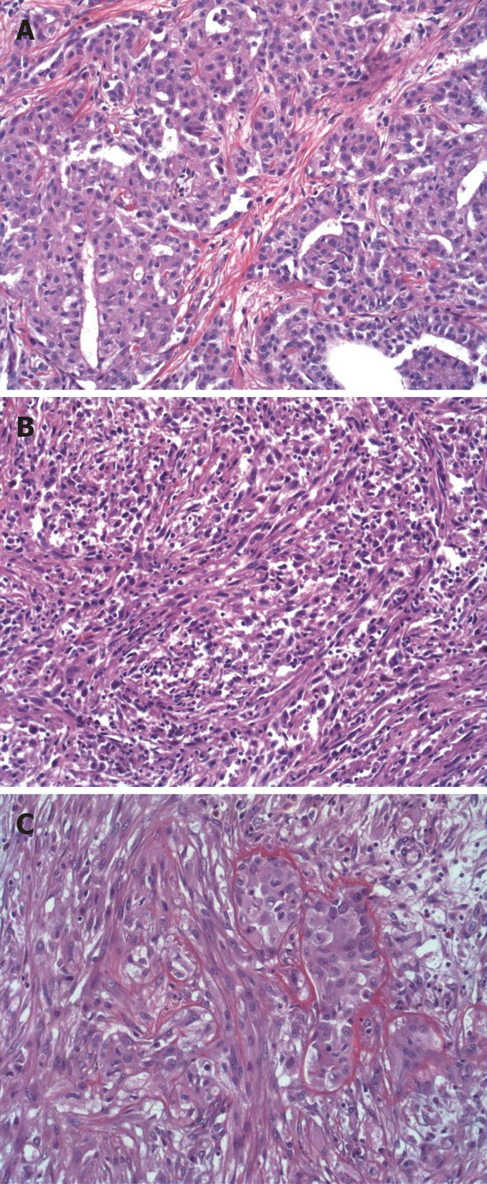 malignant-peritoneal-mesothelioma-bursahaga-com