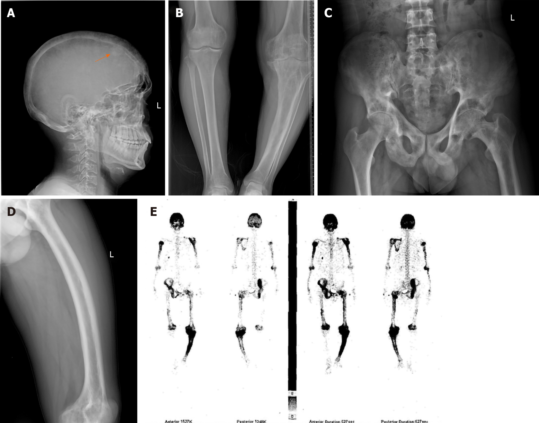 Paget's disease of bone: Report of 11 cases