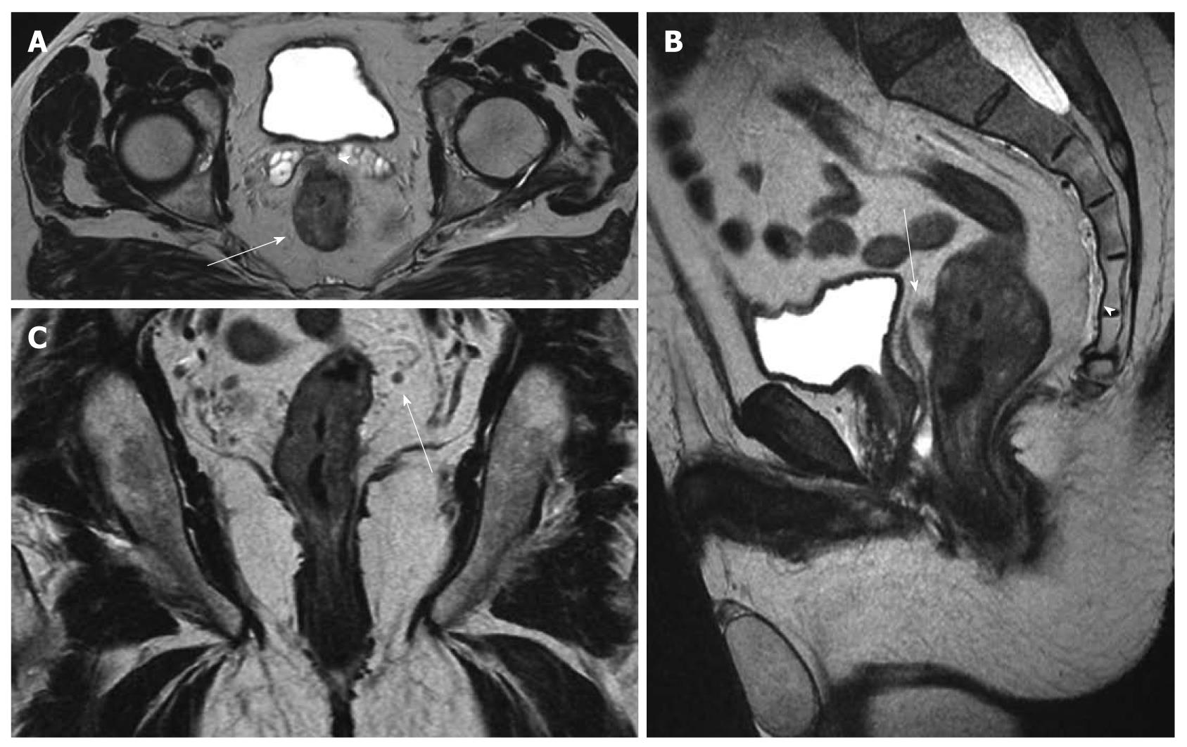 sarcoma cancer of the soft tissue simptome lamblia la copii