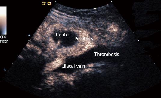 groin lymph nodes ultrasound