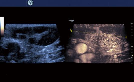 New Ultrasound Techniques For Lymph Node Evaluation