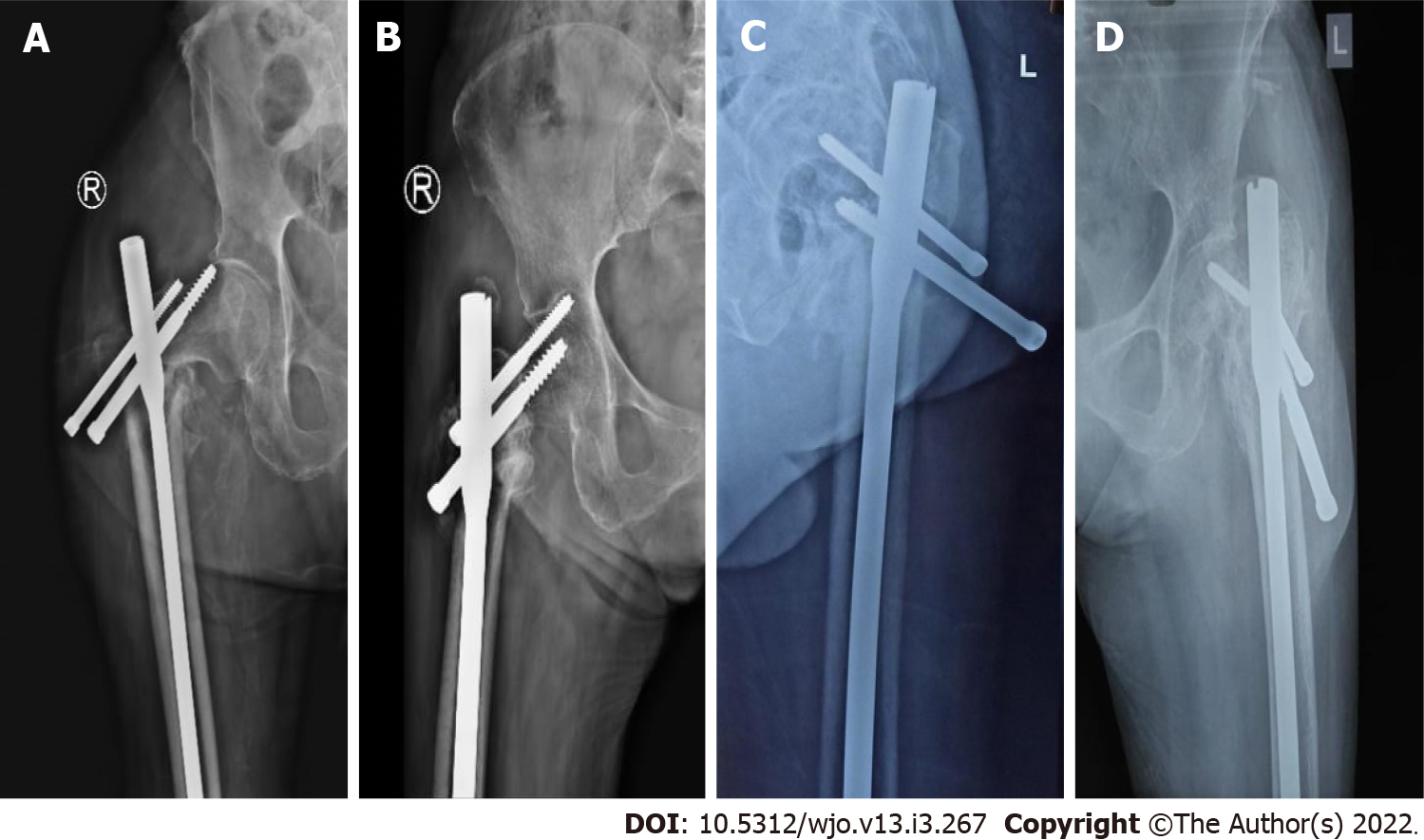 Comparative study of intertrochanteric fracture fixation using proximal  femoral nail with and without distal interlocking screws