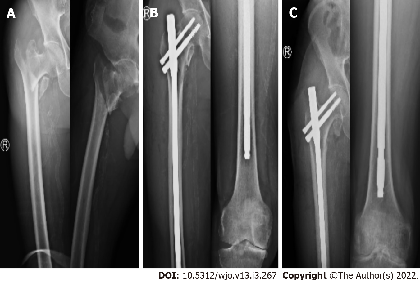 Complications following the treatment of trochanteric fractures with the gamma  nail | Archives of Orthopaedic and Trauma Surgery