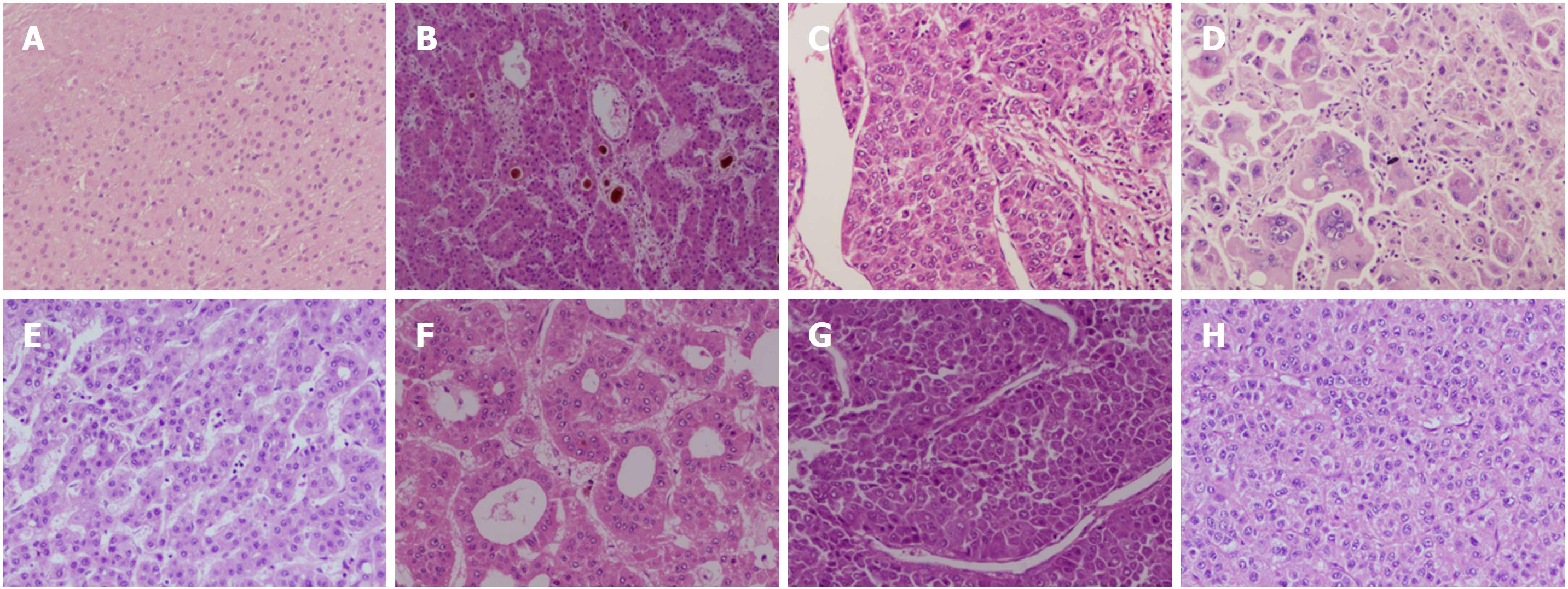 hepatocellular carcinoma histology