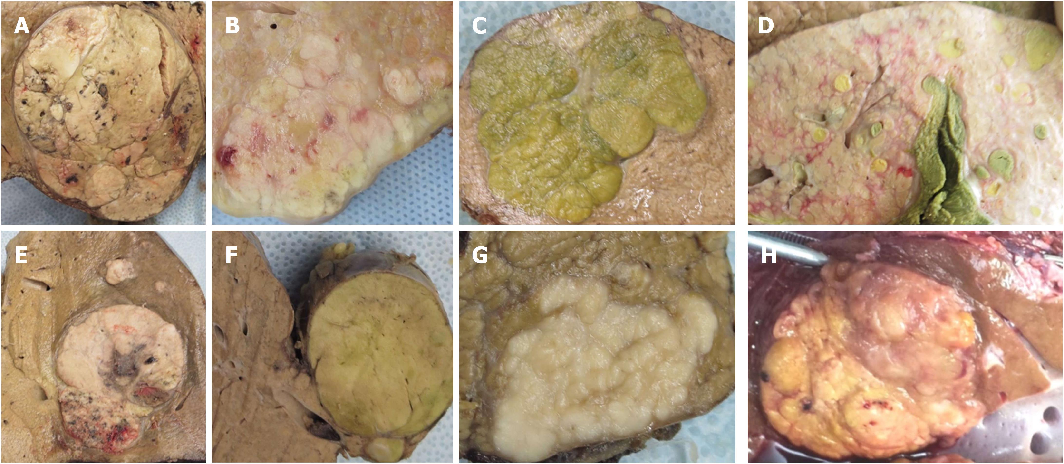 hepatocellular carcinoma gross