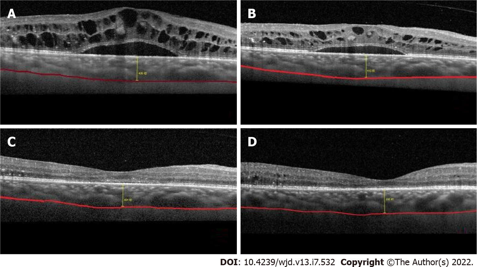 Efficacy and mechanism of anti-vascular endothelial growth factor drugs for diabetic macular edema patients