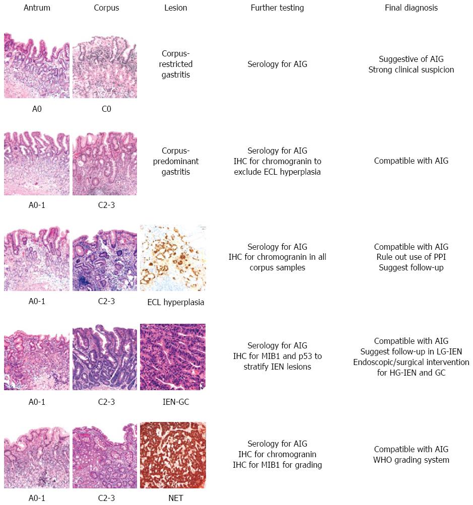 atrophic gastritis histology