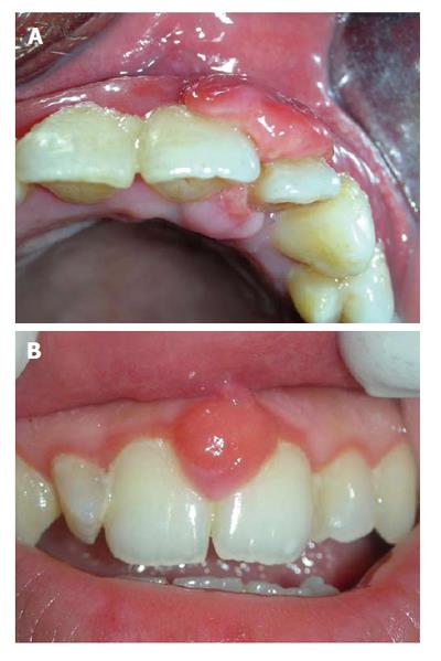 epulis pregnancy