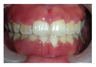 Gingival enlargements: Differential diagnosis and review of literature