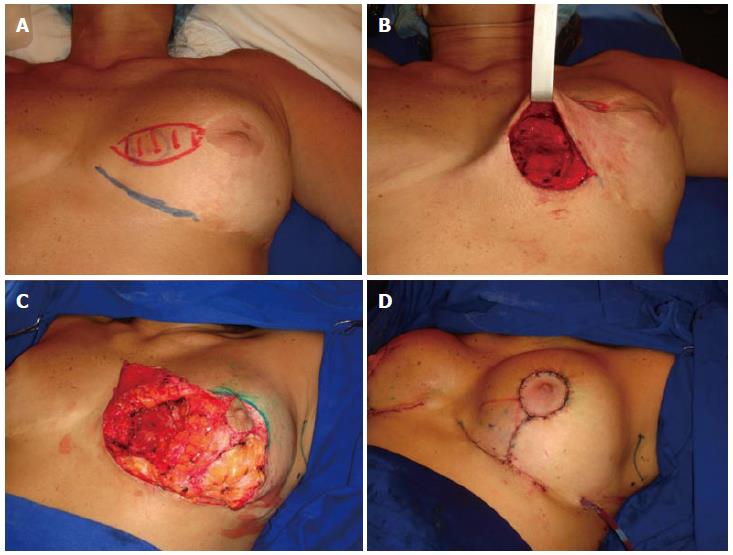 Algorithm for immediate conservative breast surgery reconstruction