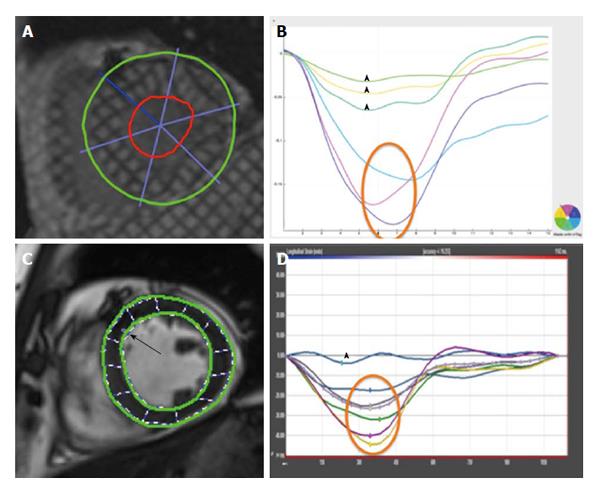 Figure 1 from Global longitudinal speckle-tracking strain is predictive of  left ventricular remodeling after coronary angioplasty in patients with  recent non-ST elevation myocardial infarction.