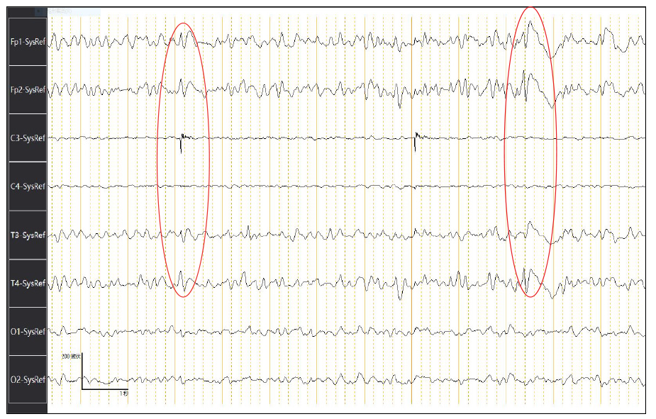 creutzfeldt jakob disease eeg