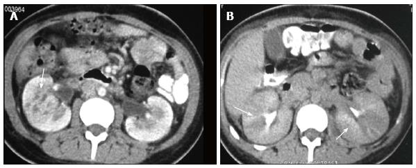 chronic pyelonephritis ultrasound