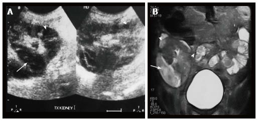 xanthogranulomatous pyelonephritis ultrasound