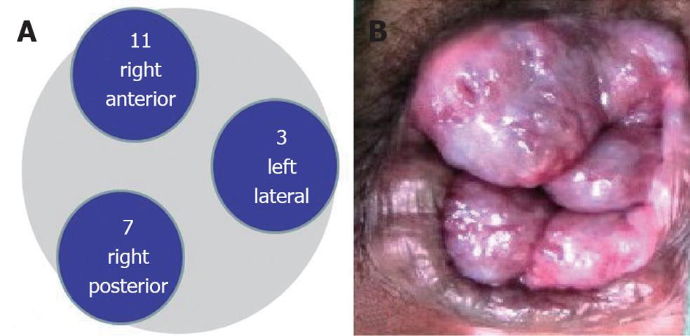 prolapsed hemorrhoid vs external