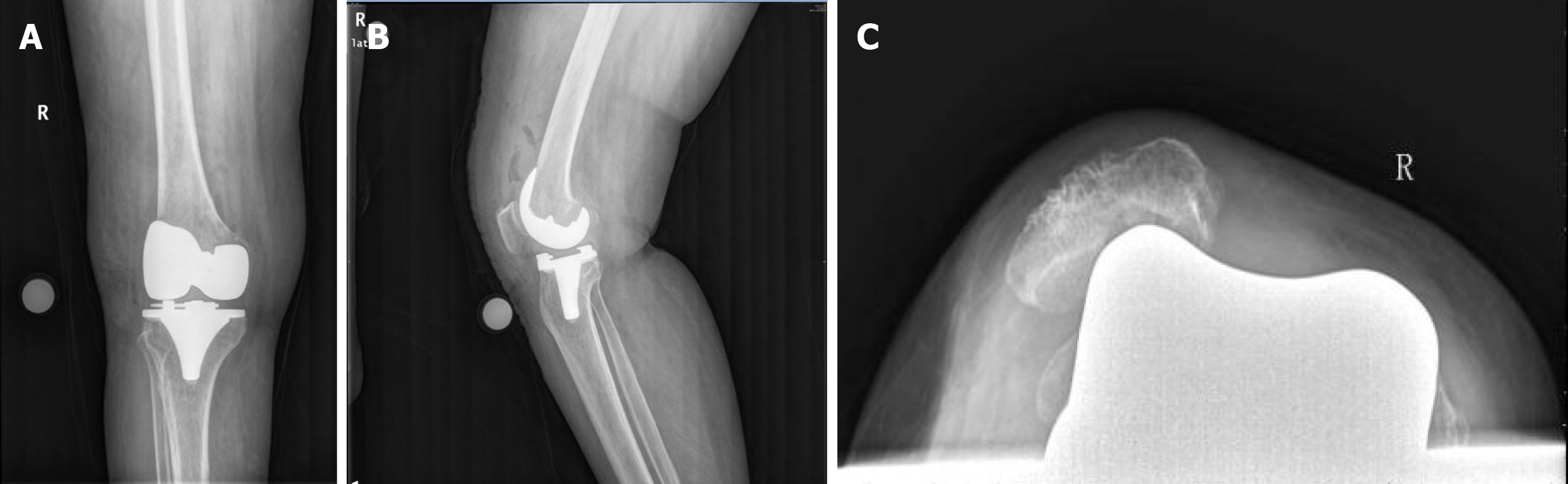 Knee Patellar Dislocation X Ray