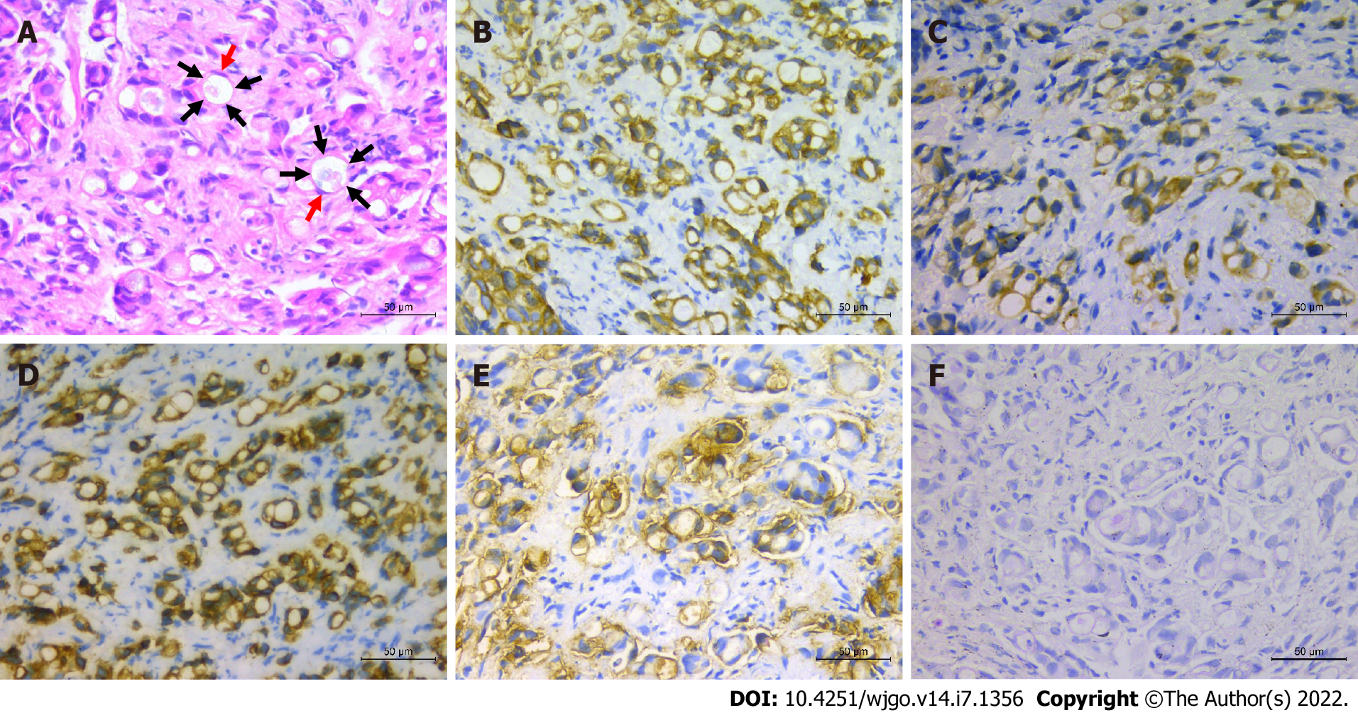 Frontiers | Case report: Preclinical efficacy of NEDD8 and proteasome  inhibitors in patient-derived models of signet ring high-grade mucinous  colorectal cancer from a Lynch syndrome patient