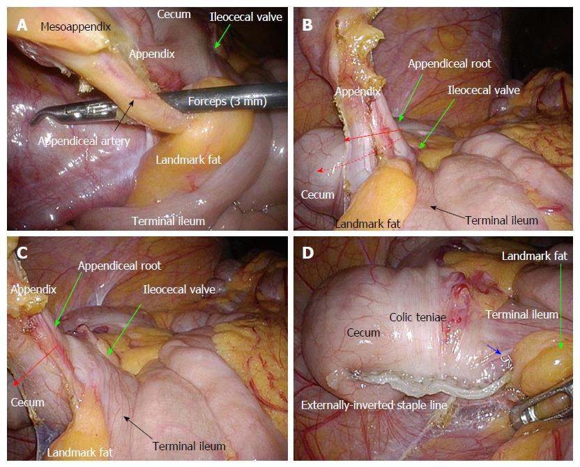 Laparoscopic view. (A) Previously ruptured contents of the right