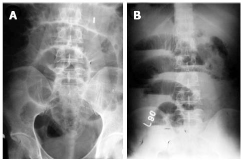 Abdominal tuberculosis of the gastrointestinal tract: Revisited