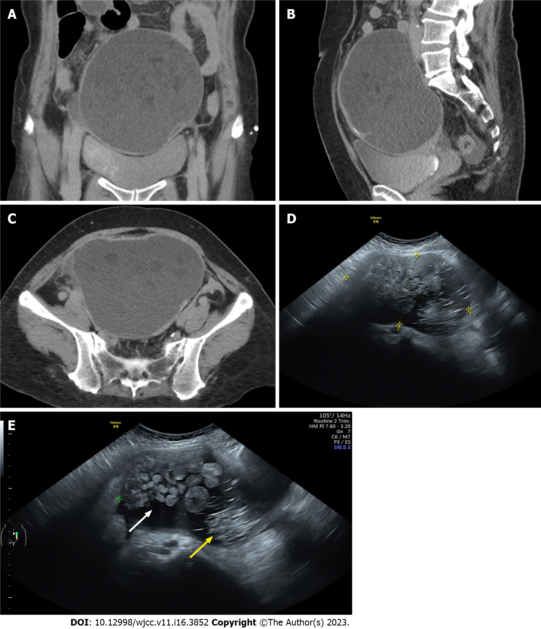 Cystic Teratoma Ultrasound Cystic Teratoma Ultrasound
