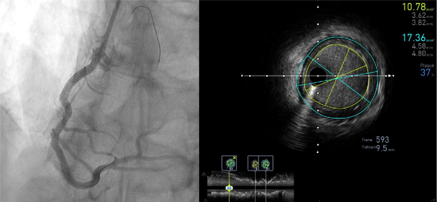 Roadmap Fusion Imaging in Percutaneous Coronary Intervention