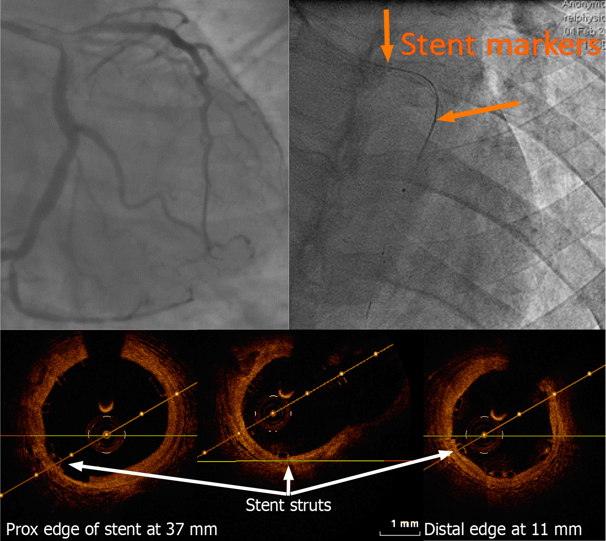 Stent visualization methods to guide percutaneous coronary