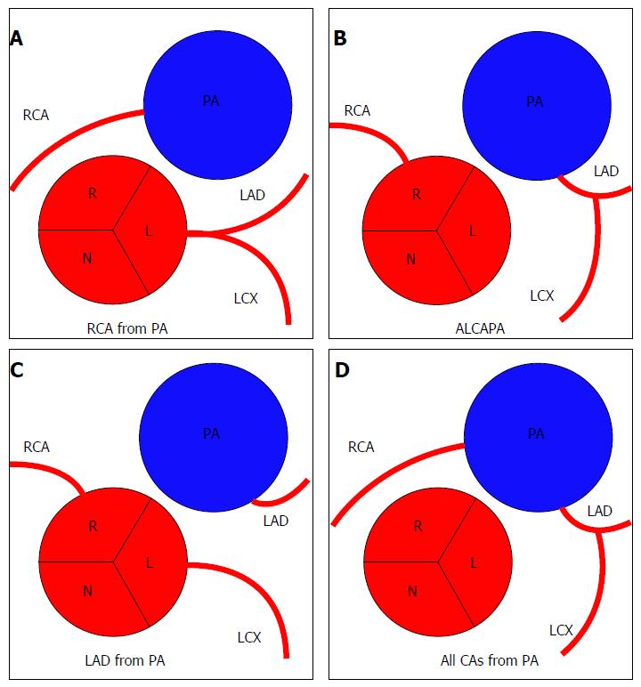 Coronary Artery Anomalies Overview The Normal And The Abnormal