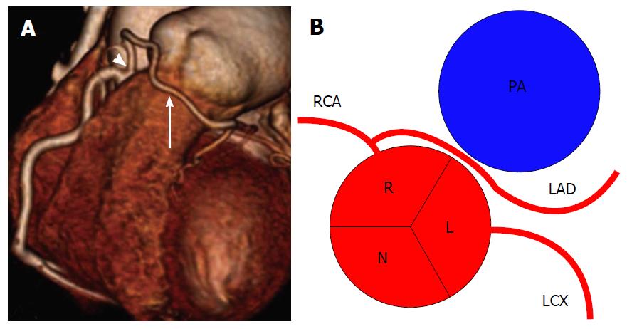 Coronary Artery Anomalies Overview The Normal And The Abnormal