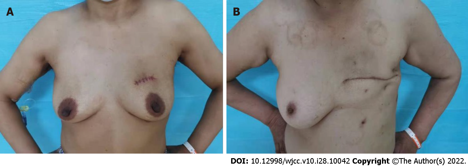 Experimental samples: (a) conventional mastectomy bra (outer), (b)