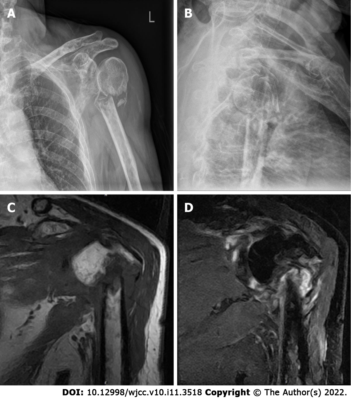 Treatment of Three-and Four-Part Proximal Humerus Fractures by MultiLoc  Nailing Technique- A Prospective Study
