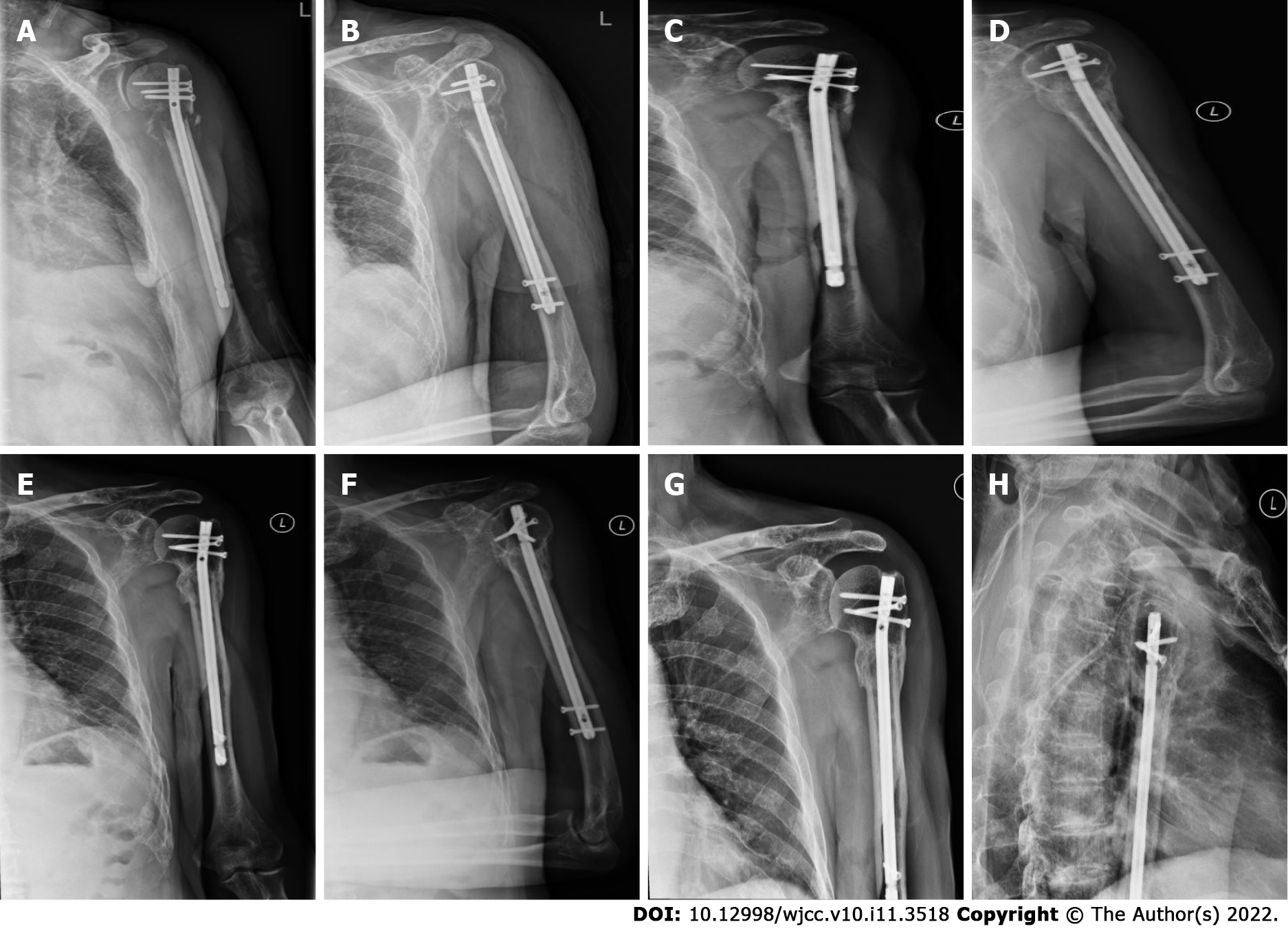Ultrasound evaluation of the rotator cuff after osteosynthesis of proximal  humeral fractures with locking intramedullary nail