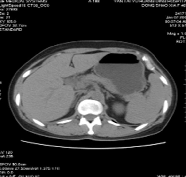 Gastric outlet obstruction caused by heterotopic pancreas: A case report and a quick review